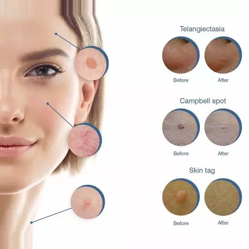 What Is Electrocautery?