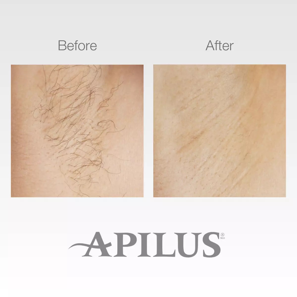 Apilus Senior 3G Epilator