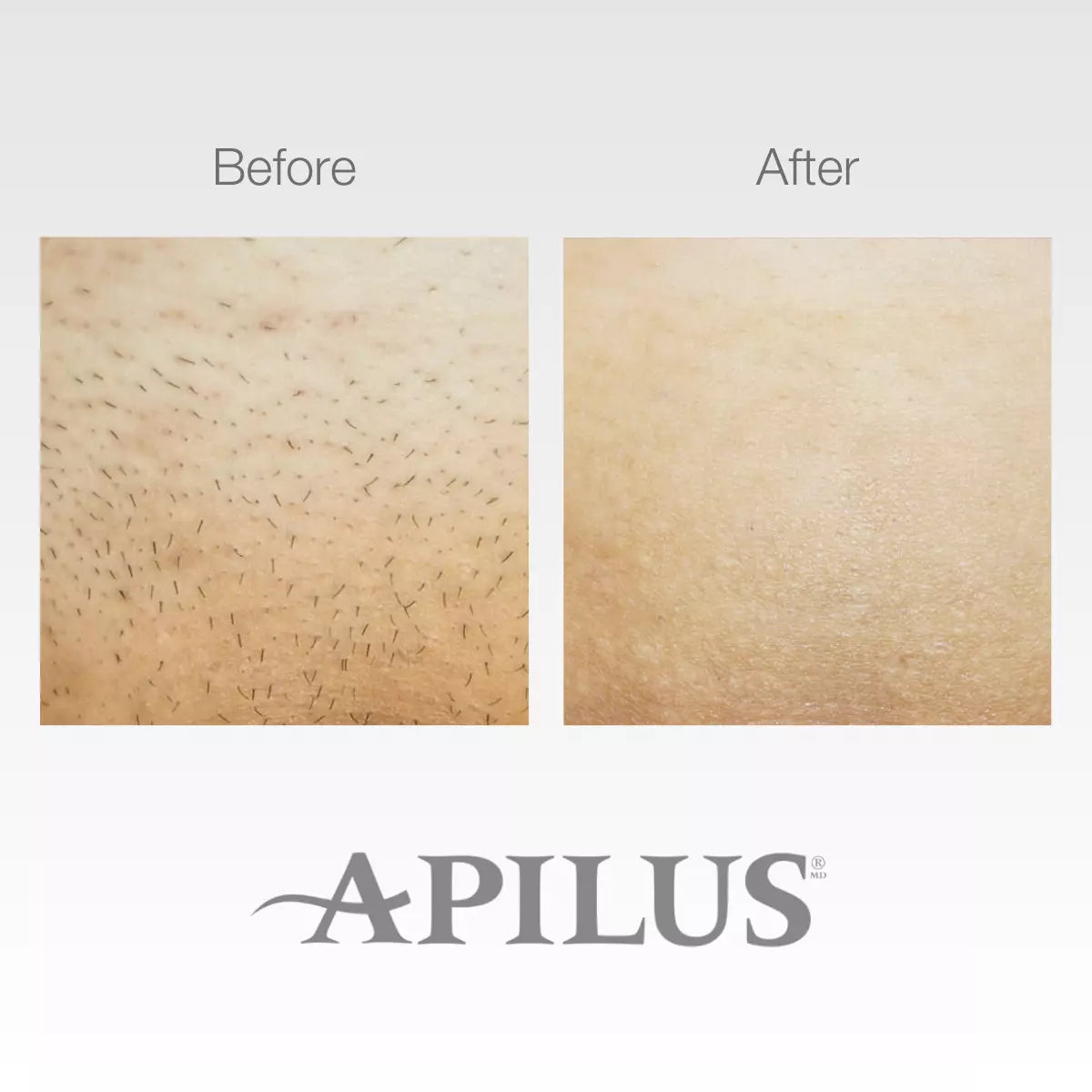 Apilus Senior 3G Epilator