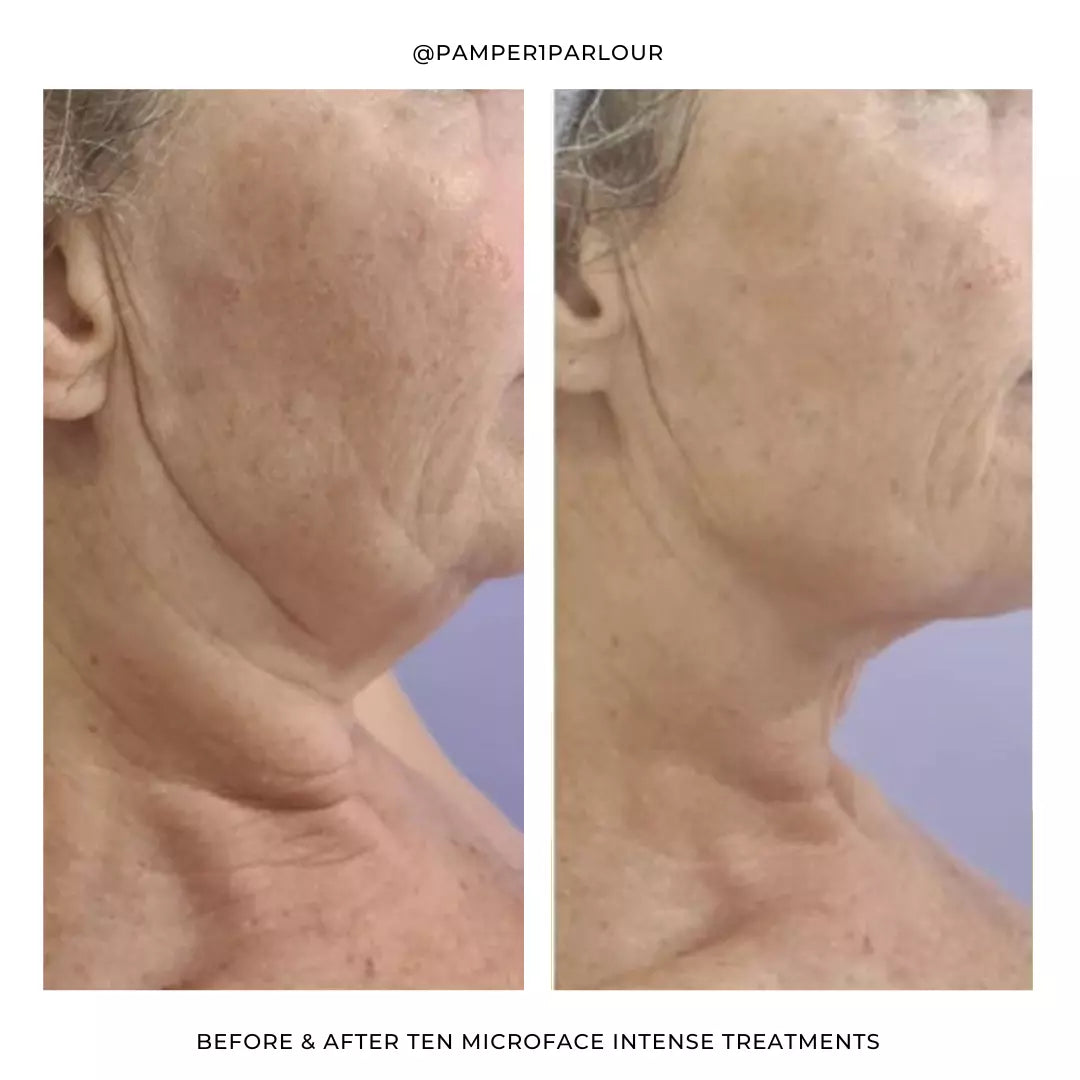 Silhouette Microface Intense