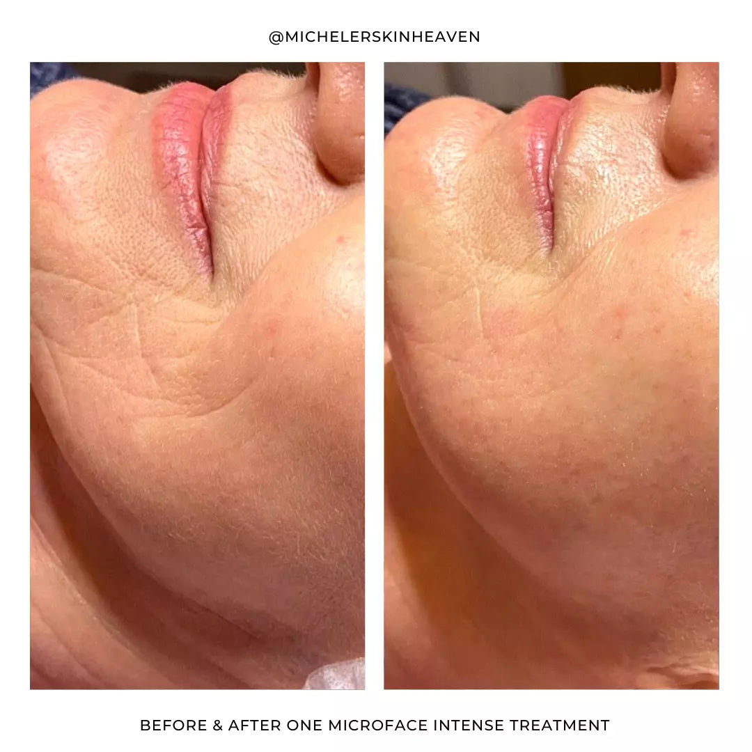 Silhouette Microface Intense