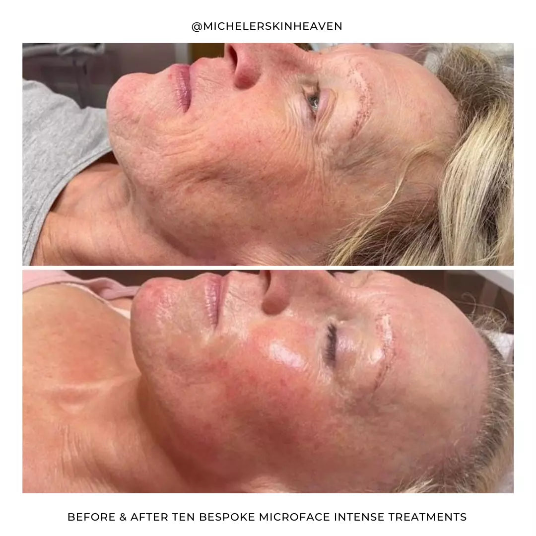Silhouette Microface Intense