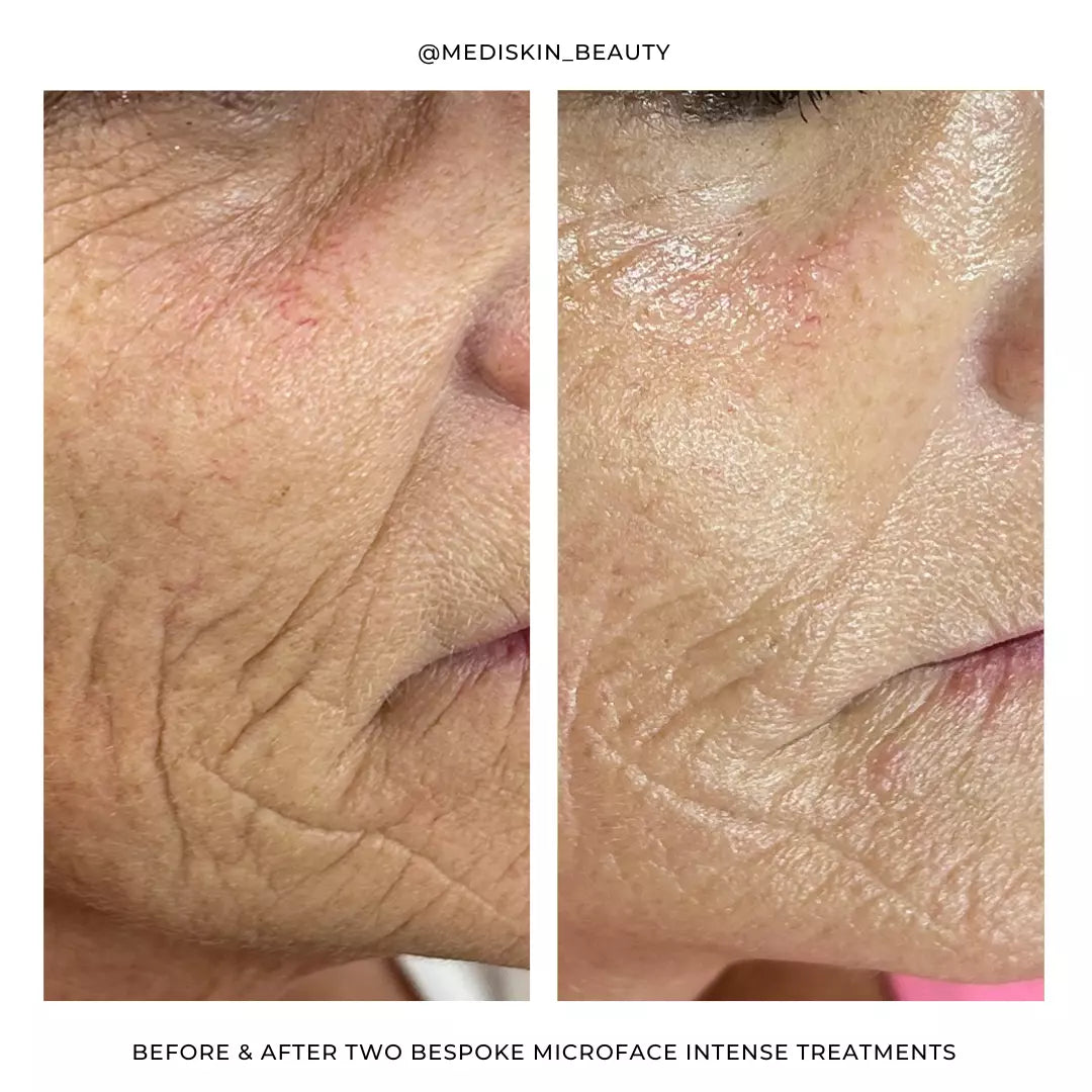 Silhouette Microface Intense