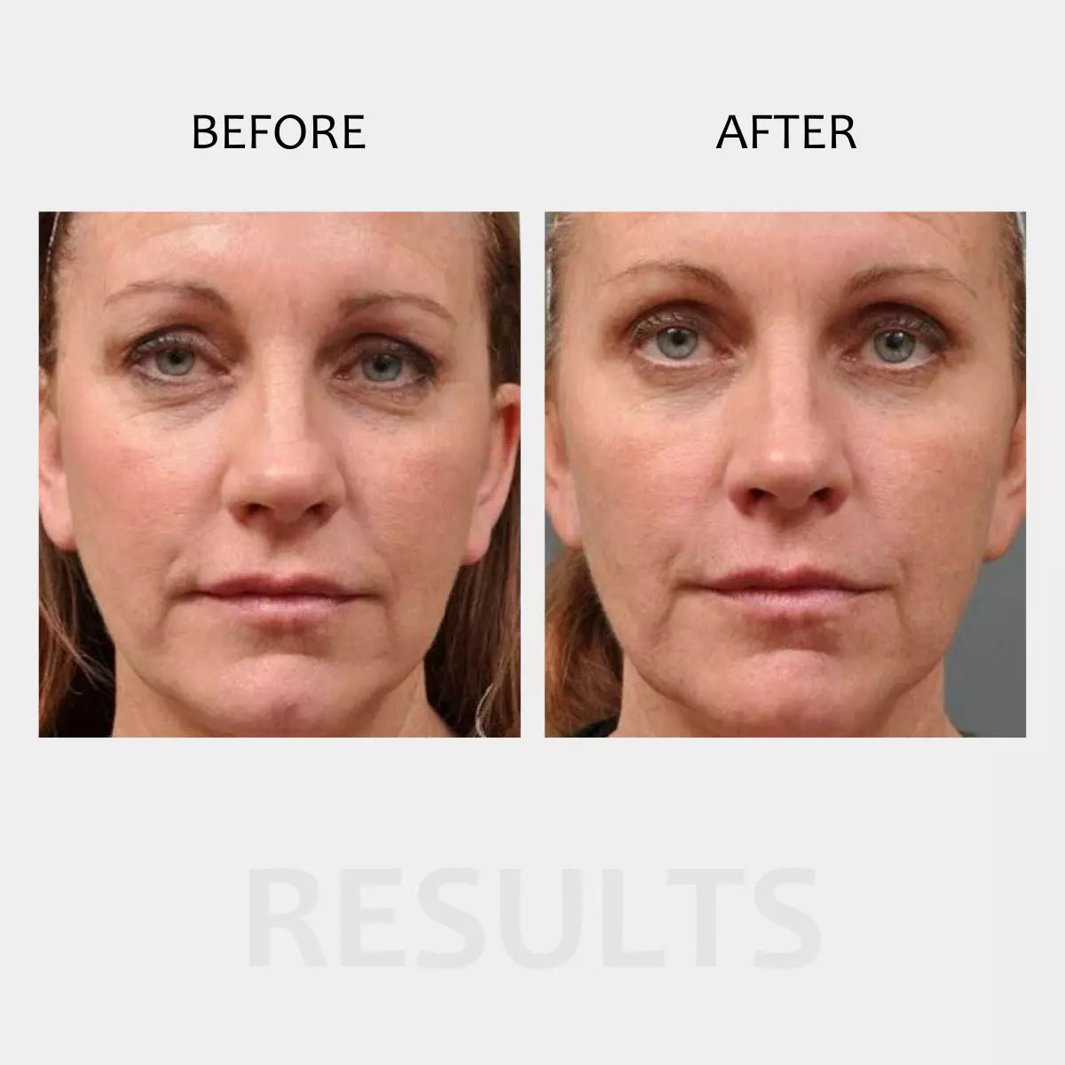 mccosmetics Dermapen