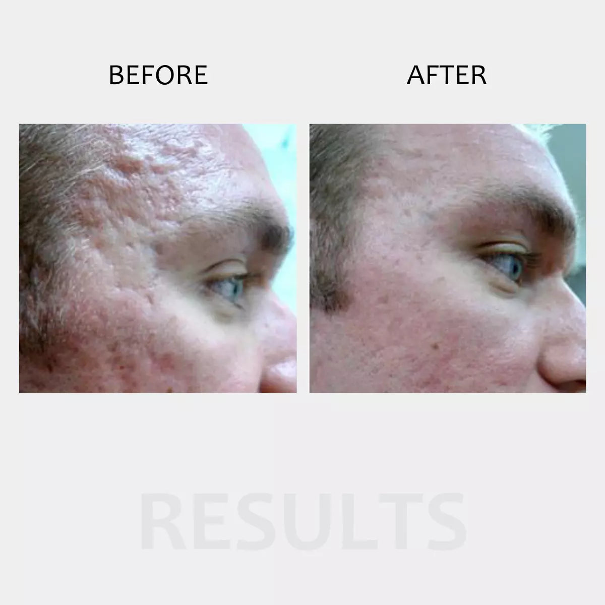 mccosmetics Dermapen
