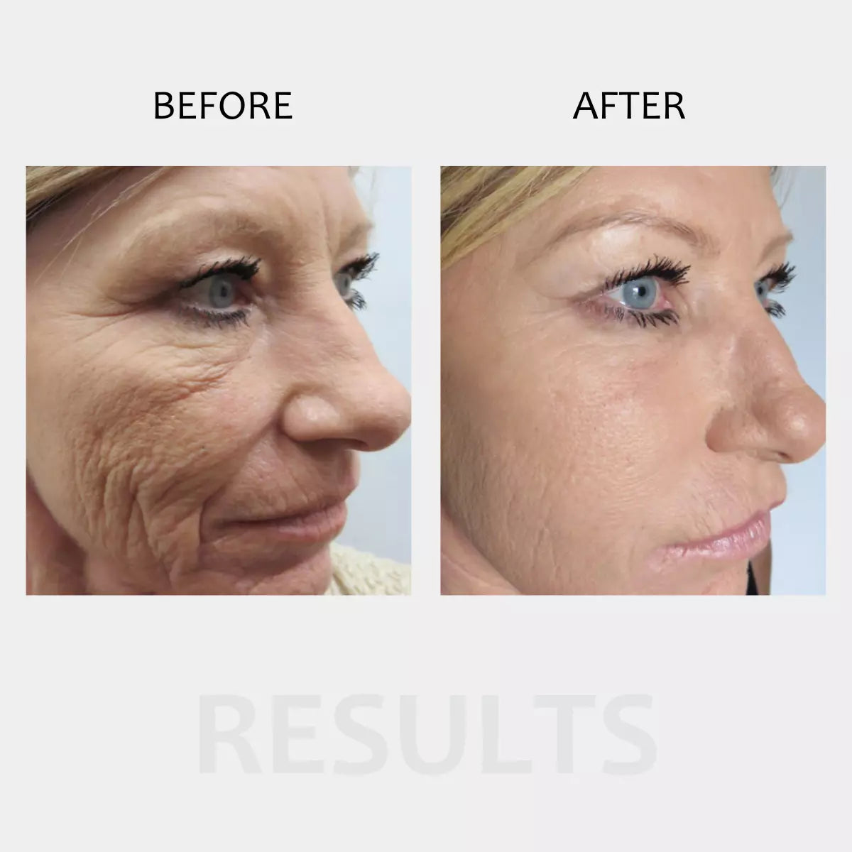 mccosmetics Dermapen