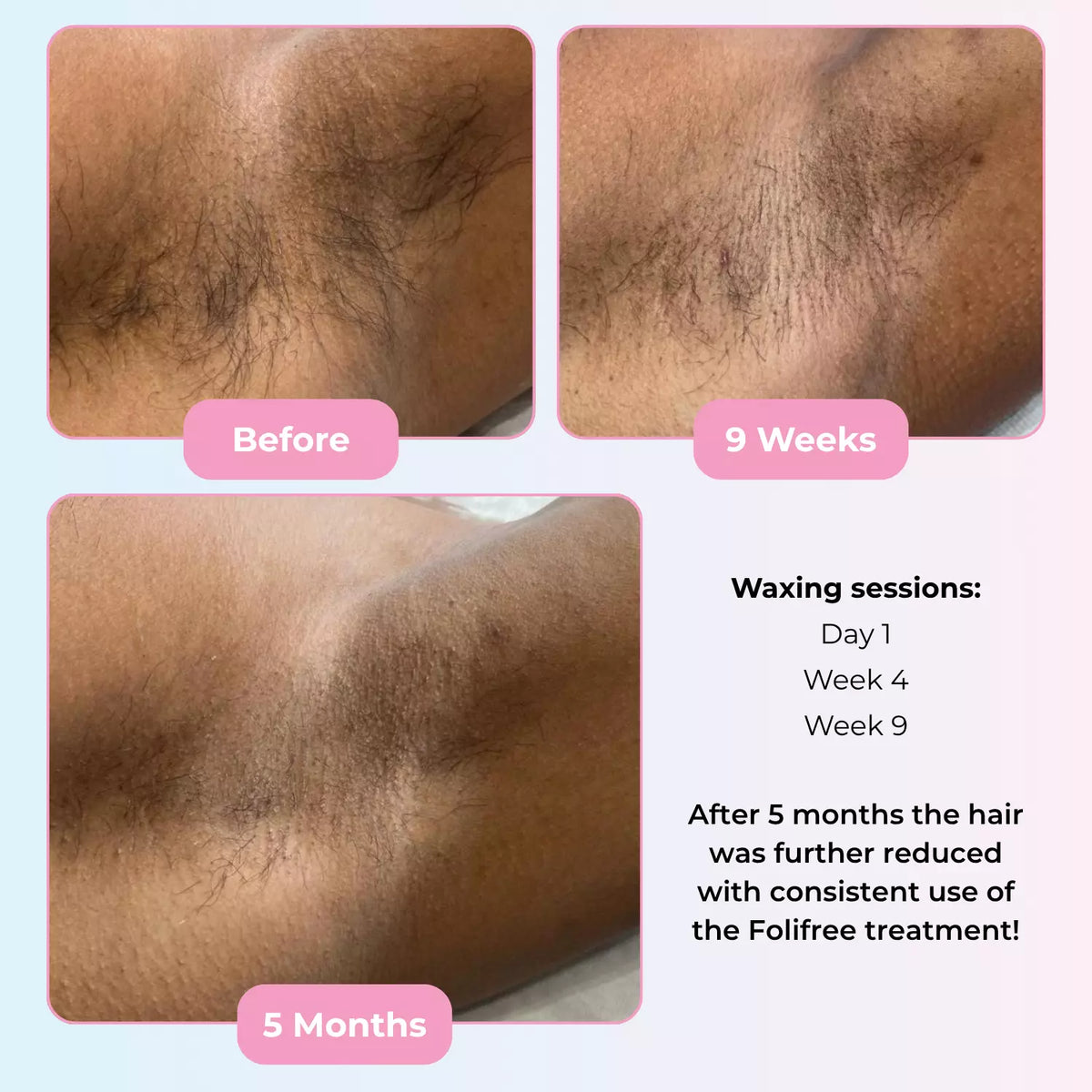 Depileve Folifree Vanish Hair Serum Step 2 - 200ml