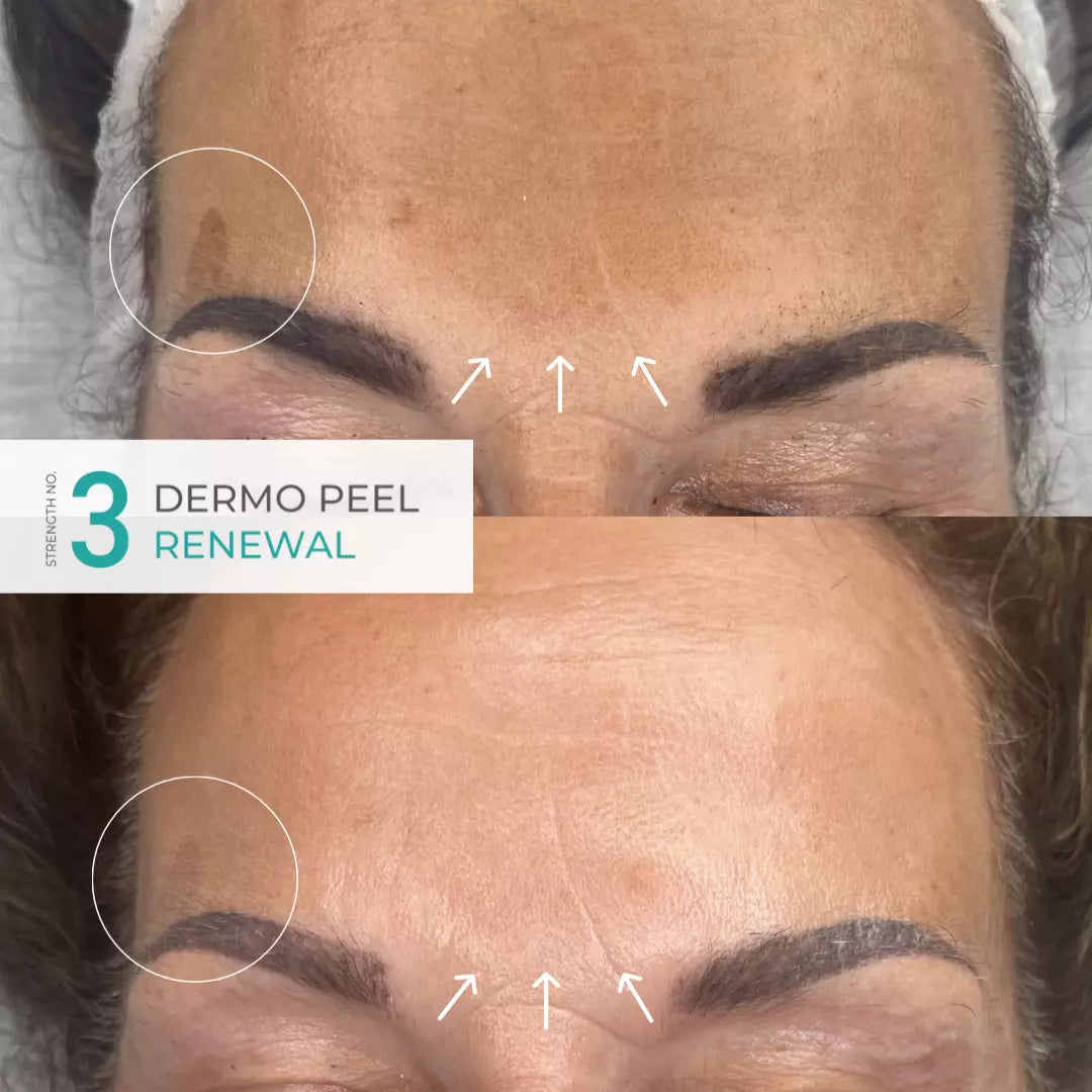 Anesi Lab Dermo Peel Renewal - Strength No.3